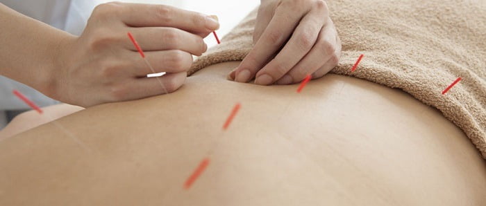 Acupunctuur helpt bij vele klachten